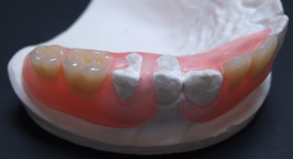 ノンクラスデンチャー